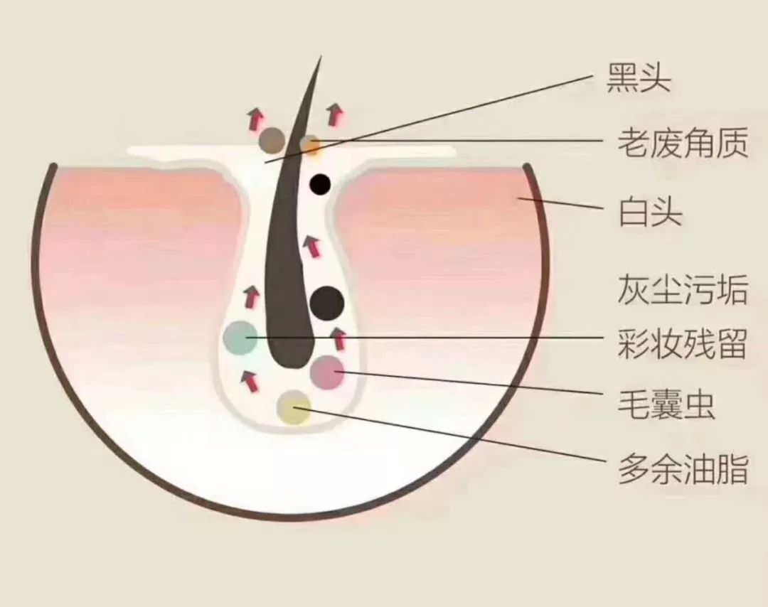 怎样才能深层清洁皮肤毛孔,做完皮肤深层清洁为什么爆痘