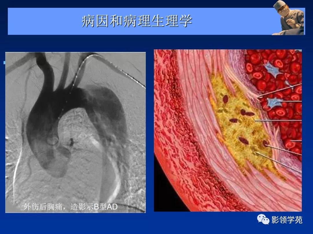 主动脉夹层壁间血肿如何鉴别,主动脉夹层血肿溃疡