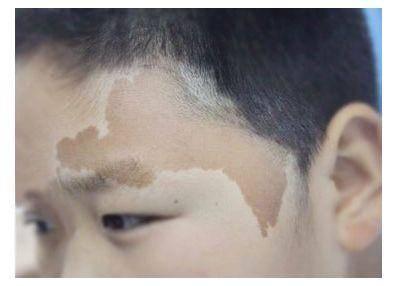 宝宝为什么出生后身上有很多青块,宝宝出生为什么有青胎记