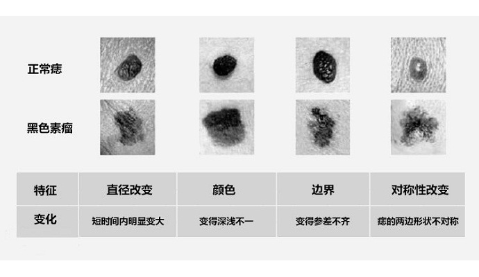 色素痣怎么治疗最为稳妥,色素痣如何知道是否癌变