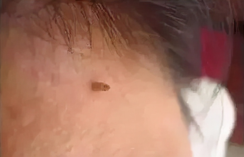 身体上长出很多小肉粒是什么原因,皮肤长了个凸起的小肉球怎么回事