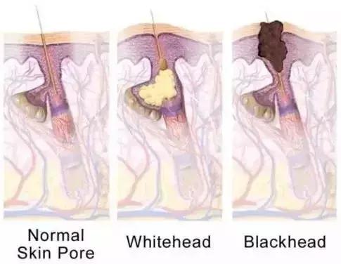 怎么正确用凡士林去黑头,凡士林去黑头修复怎么用