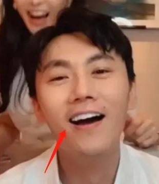 吴宣仪做牙齿前后对比,吴宣仪做整牙