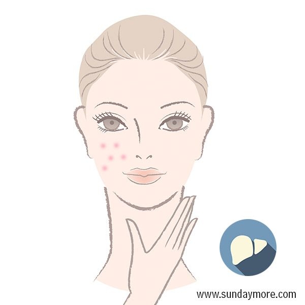 暗疮最好的消除方法 (暗疮印最佳治疗方法)