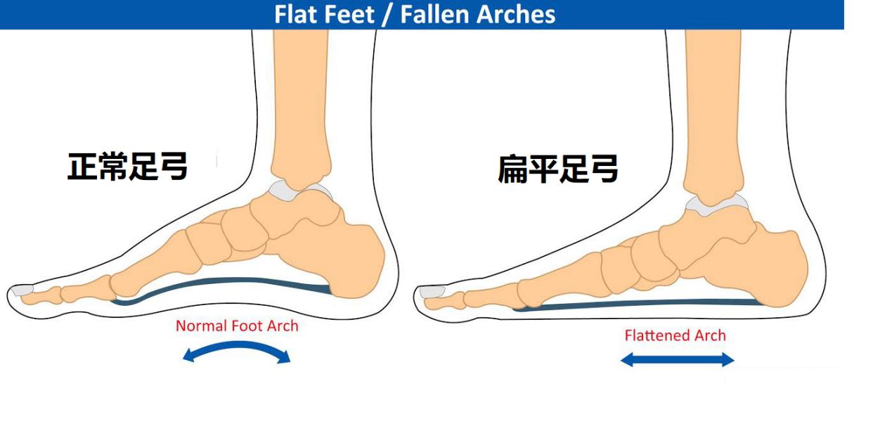 治疗扁平足,聊聊足弓塌陷