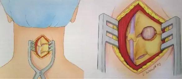 低头族颈椎最好的治疗方法,低头族怎么治好颈椎