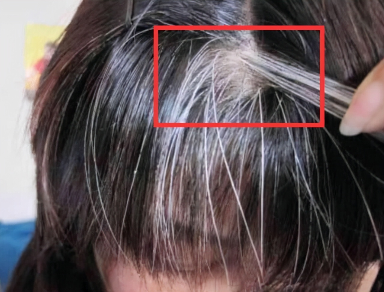 两鬓和后脑勺白发是什么原因,白发长在不同部位代表什么