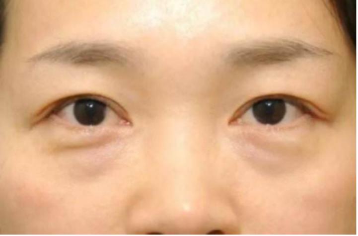 你知道卧蚕和眼袋的区别吗,别把卧蚕当眼袋