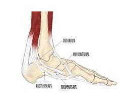 有扁平足、足弓塌陷的你要注意“胫骨后肌腱失能”