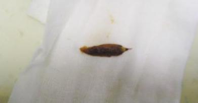 老人误吞枣核食道穿孔,吃枣核卡住身亡