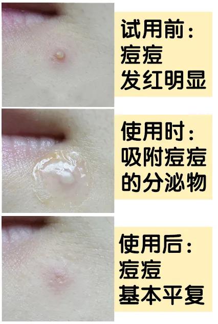 片仔癀淡化痘印凝胶,片仔癀祛痘痘贴有用吗