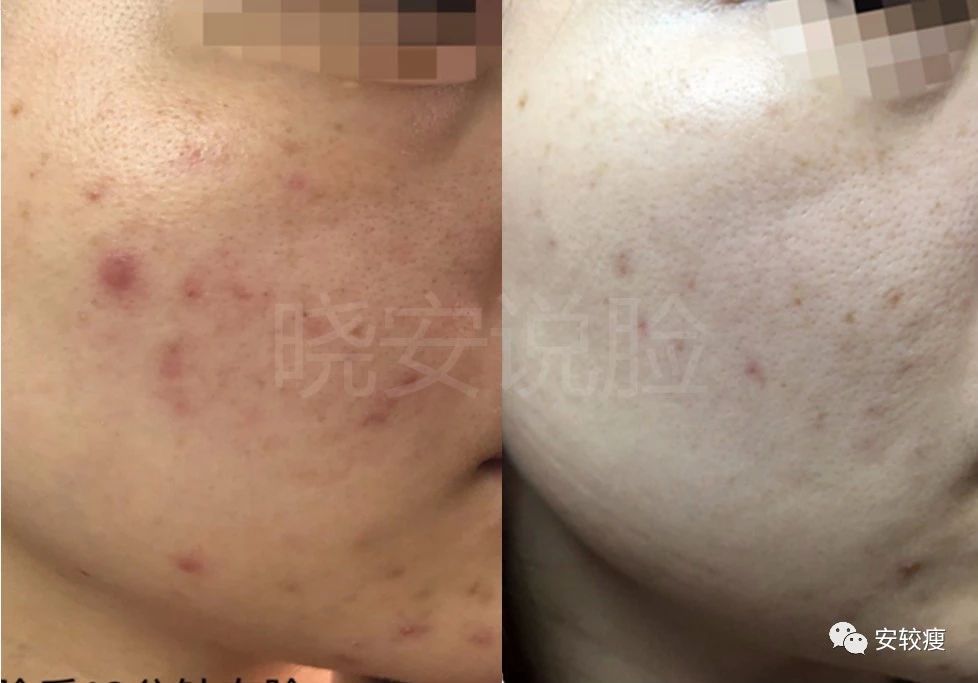 外油内干敏感痘肌怎么护肤,30岁油皮痘痘敏感肌怎么改善