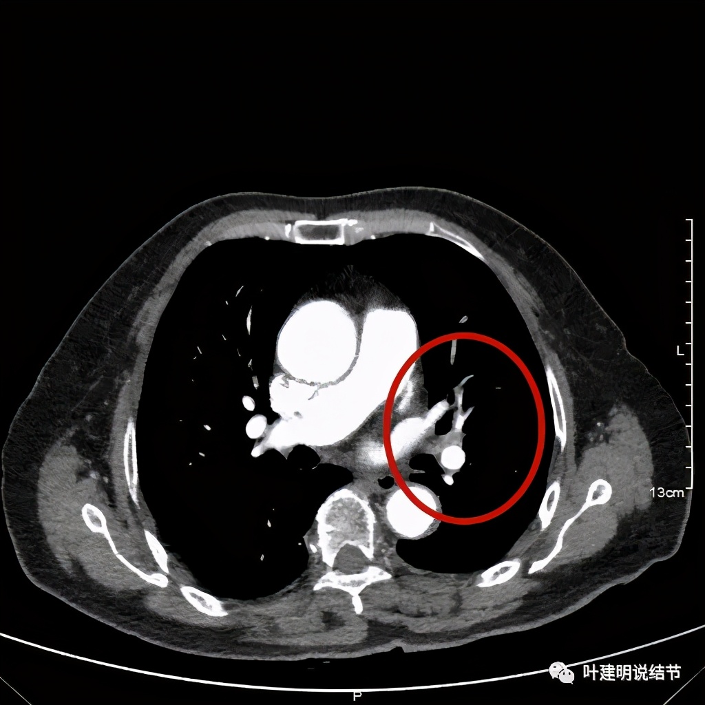 卡瑞利珠单抗治疗肺鳞癌有用吗,特瑞普利单抗对鳞癌治疗有效吗