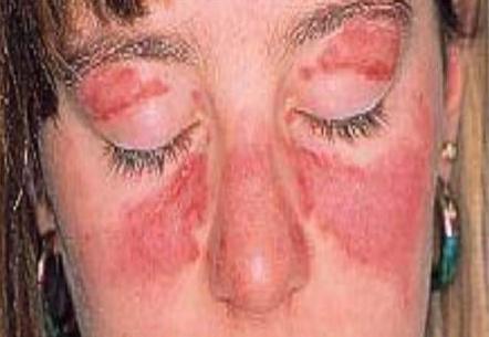 尿蛋白是怎么回事啊,尿蛋白是怎么回事能危及生命吗