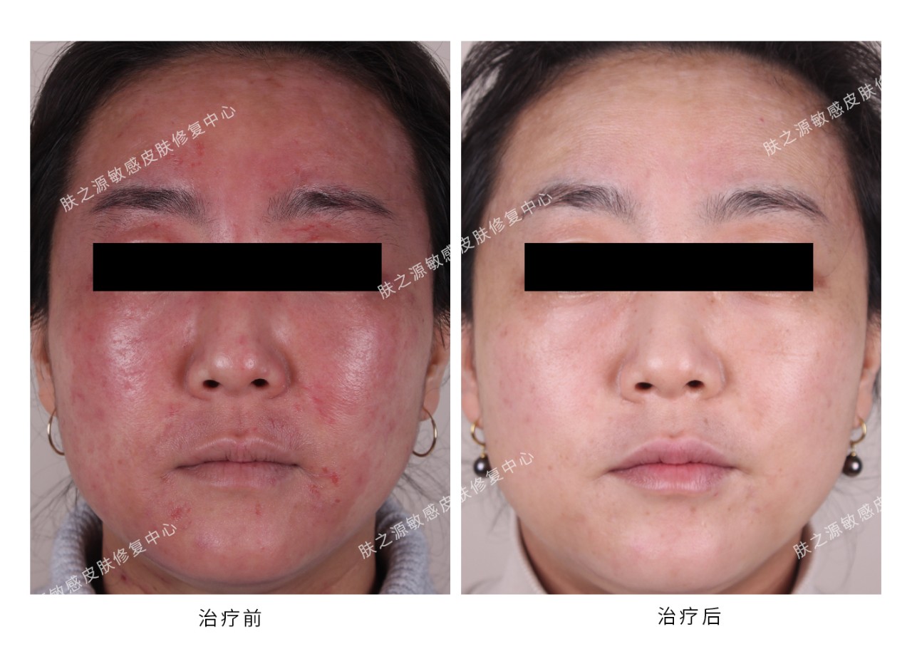 激素面膜曝光,药监局曝ray面膜含激素