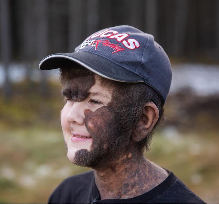 美国男孩患罕见疾病,美国男孩患绝症