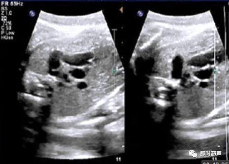 胎儿心脏三种血管关系模式图,25周的胎儿心脏弓切面多少正常