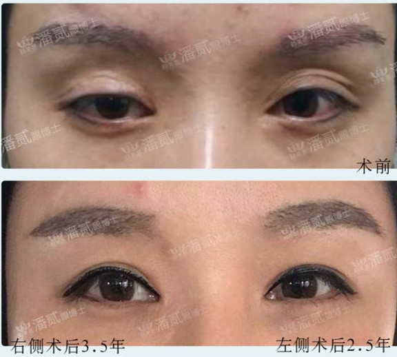 双眼皮修复有失败的吗,双眼皮修复失败了会怎样