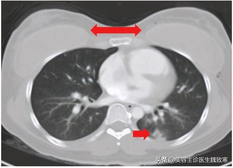 私密整形严重并发症：阴道注射填充剂9小时后永久停止呼吸