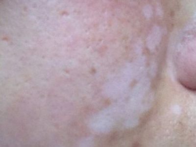 皮肤上长白癜风应该怎么治?稳定期的白癜风治疗用什么方法好?