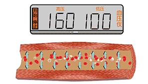 血管堵塞动态图片,血管疏通动图
