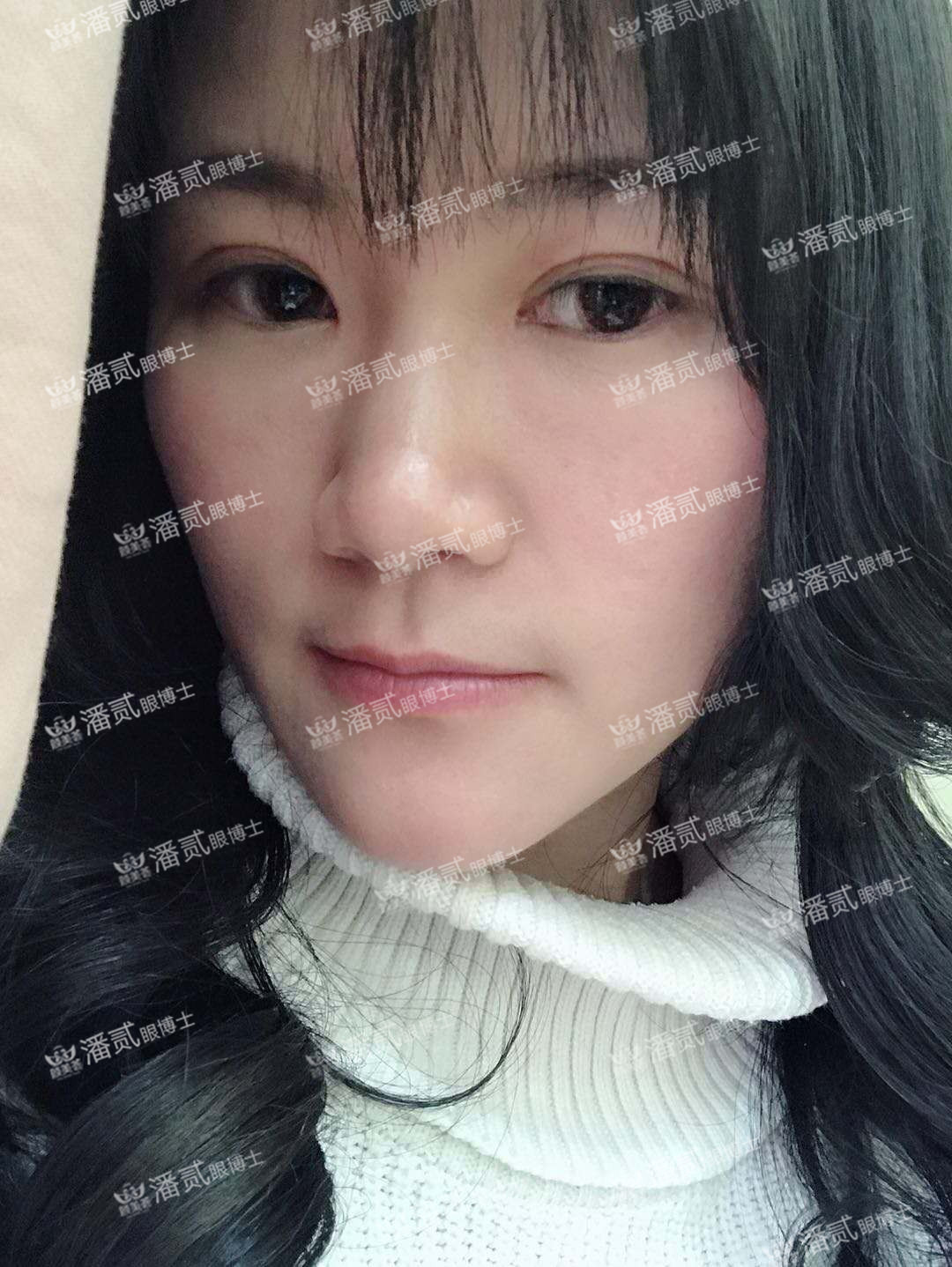 广州双眼皮凹陷修复视频,小切口双眼皮肉条修复