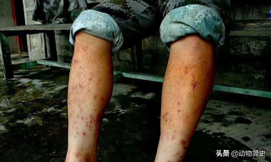 水蛭吸血救人视频,水蛭吸血疗法的正确方法