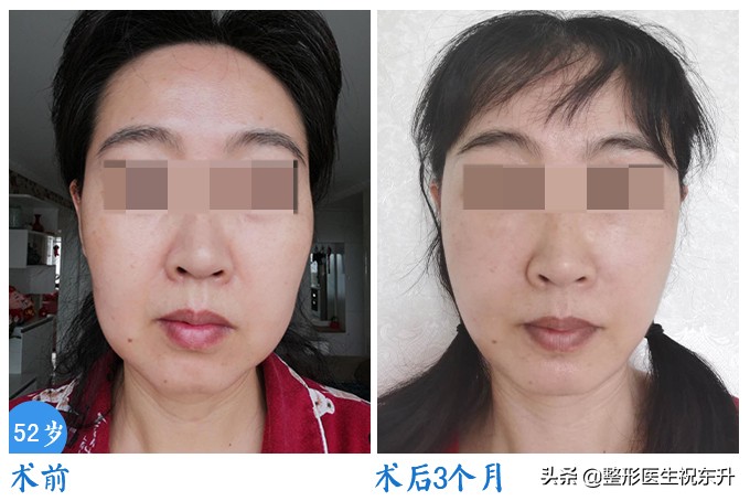 做完拉皮手术感觉效果不明显,拉皮手术后头部针刺样疼怎么回事