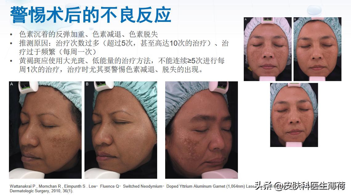 黄脸婆吃什么祛斑,告别黄脸婆自制纯中药祛斑面膜