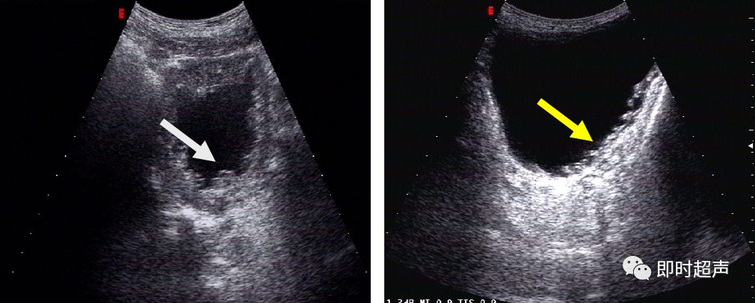 膀胱超声图解大全,膀胱超声解剖及常见病变超声表现