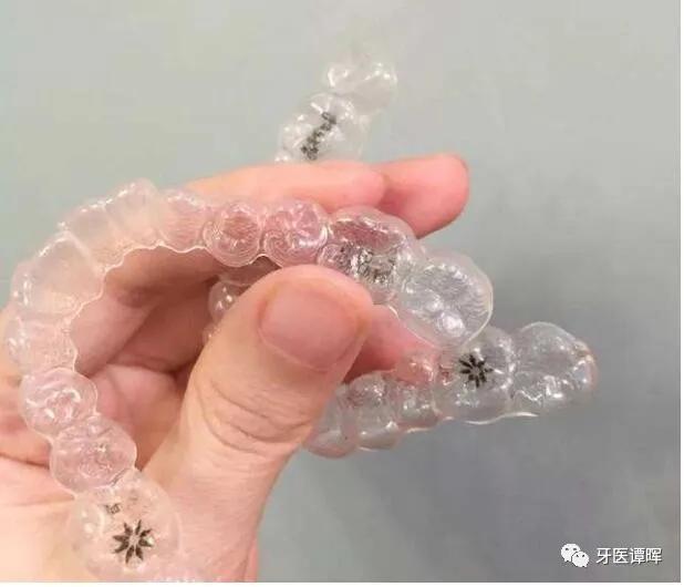 超详细的牙齿矫正过程,重叠牙齿矫正变化过程