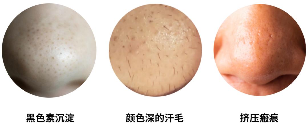 黑头毛孔粗大真的没有办法解决吗,黑头很严重毛孔粗大怎么办