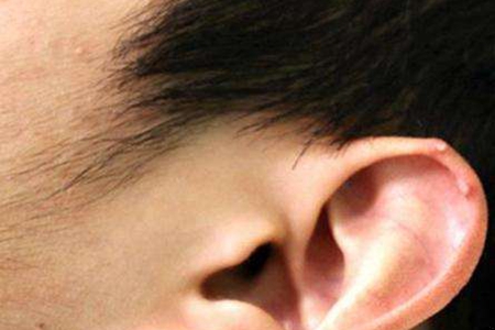 耳朵长痛风石早期症状,耳朵长痛风石是怎么样的