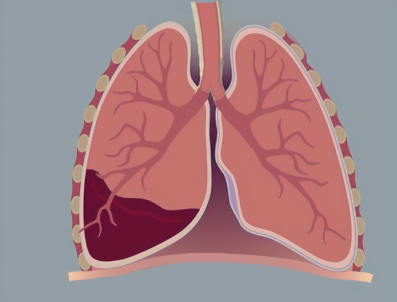 疫情期间老爸肺癌发烧39度,基因检测确诊肺癌