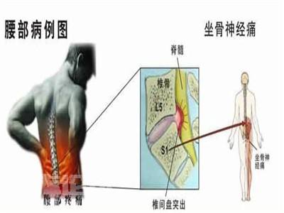 腰突压迫神经导致脚疼怎么办,脚痛无法形容的痛