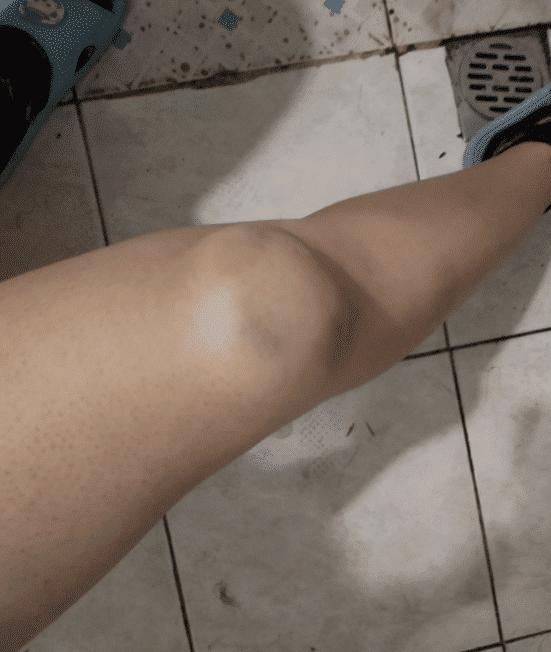 滑冰把膝盖内侧摔了怎么办,溜冰时膝盖磕破怎么办