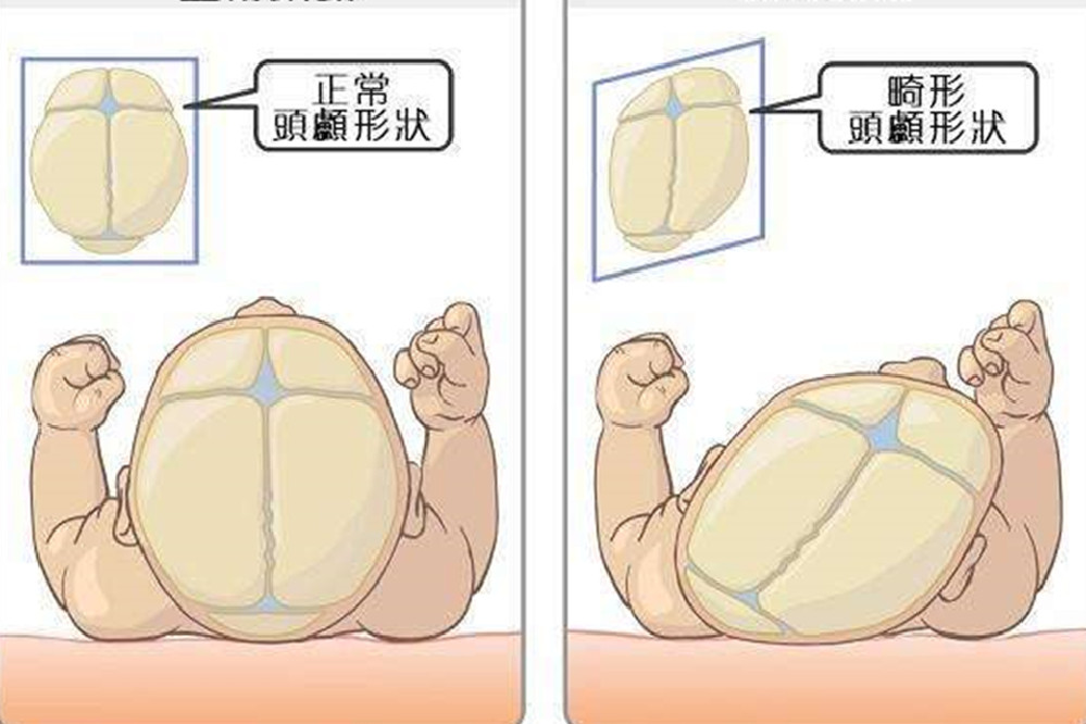 纠正宝宝偏头睡觉的小妙招,如何防止宝宝睡偏头及补救方法