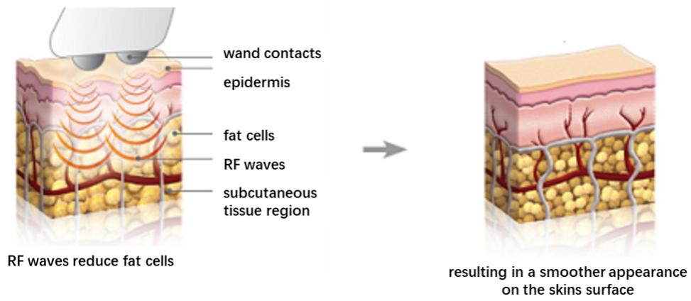 热玛吉提拉紧致皮肤的5个原理,热玛吉光子嫩肤真实感受分享