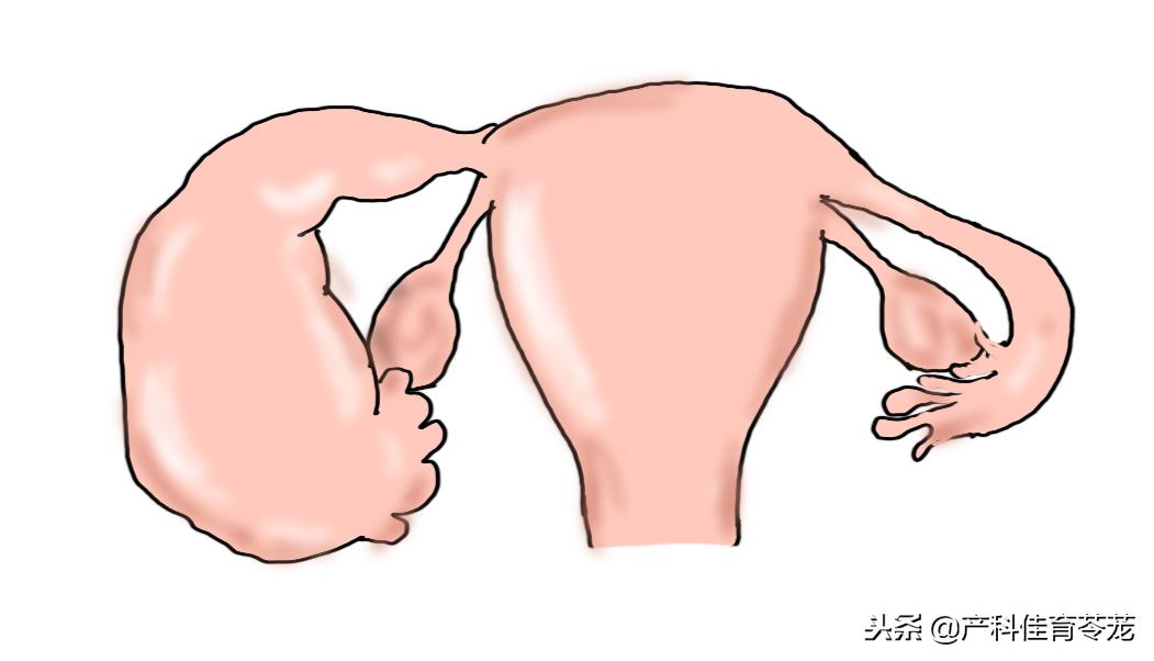 胸腔积液b超显示图,老年妇科b超检查下来有少量积液