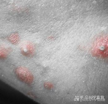 维a酸乳膏,维a酸处方图片