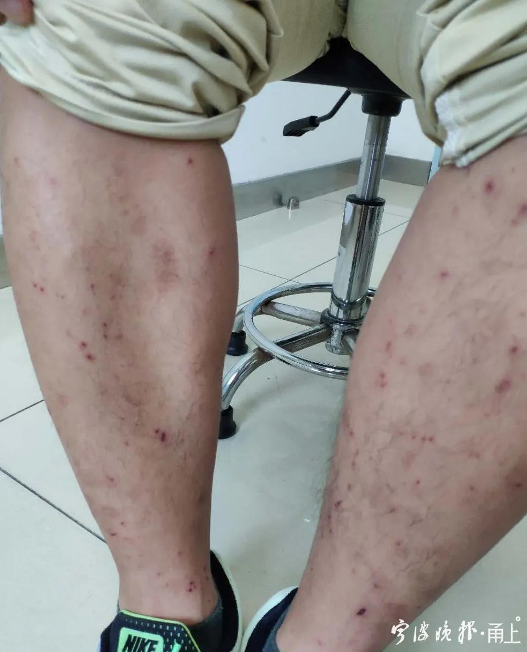 医生提醒这种病年轻人高发,25岁女性身上起红疹