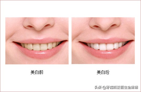 北京牙齿美白冷光美白多少钱,牙黄做冷光