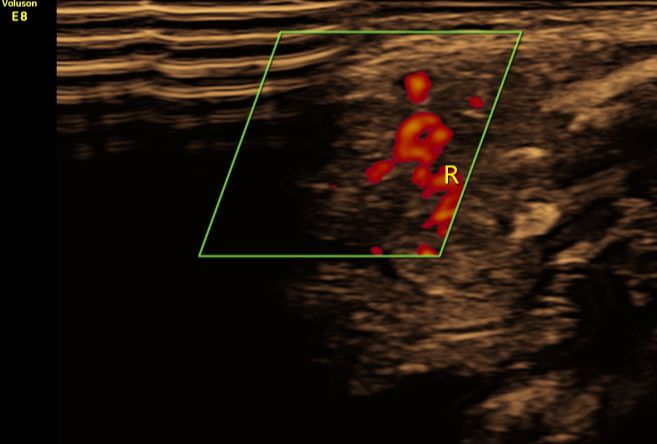 八个月大宝宝锁骨断了,新生儿锁骨断了错位
