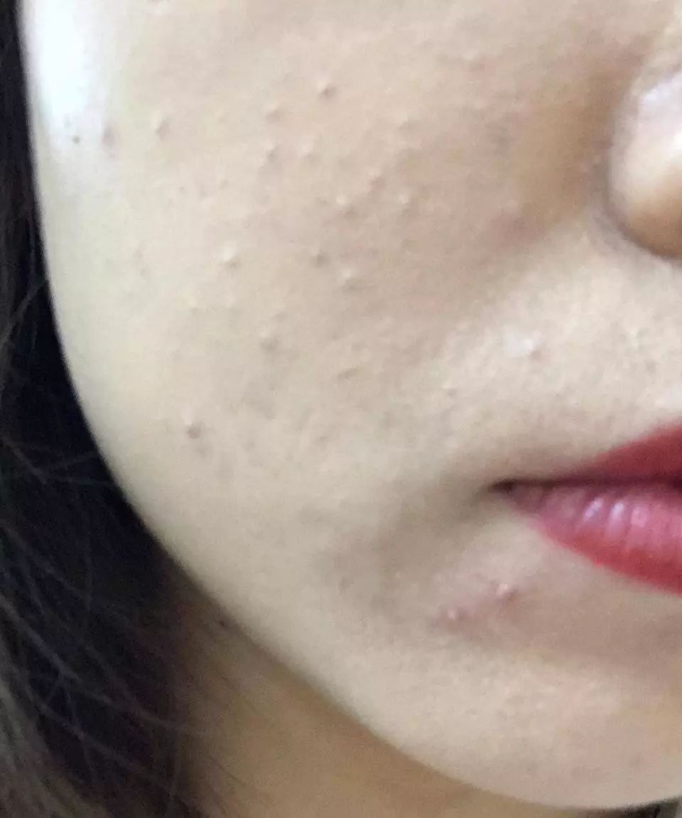 鼻子上的黑头越来越多怎么办,脸上黑头越来越多