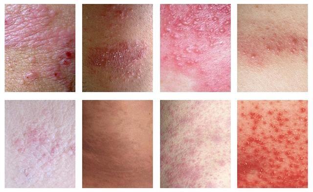 宝宝湿疹妈妈需要干预吗,宝宝湿疹反复怎么从根本解决