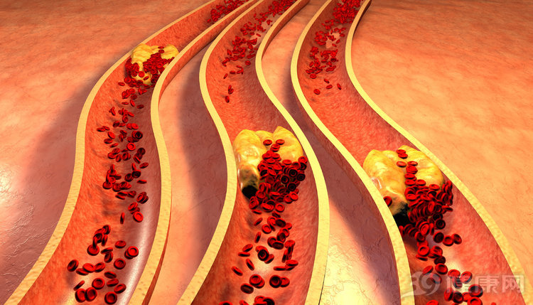 a型主动脉夹层死亡率是不是很高,急性主动脉夹层a型死亡率有多高