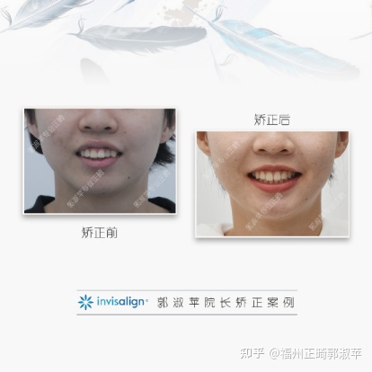 牙齿龅牙矫正过程全记录33岁,大龅牙牙齿矫正成功案例和费用