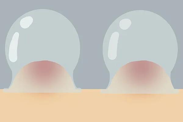 拔火罐的印子怎样快速去掉,拔火罐的印子怎样快速消除