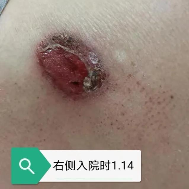 压疮的治疗成功和护理案例,压疮怎么护理好得快