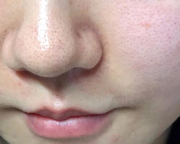 医美收毛孔价格表,医美收毛孔效果